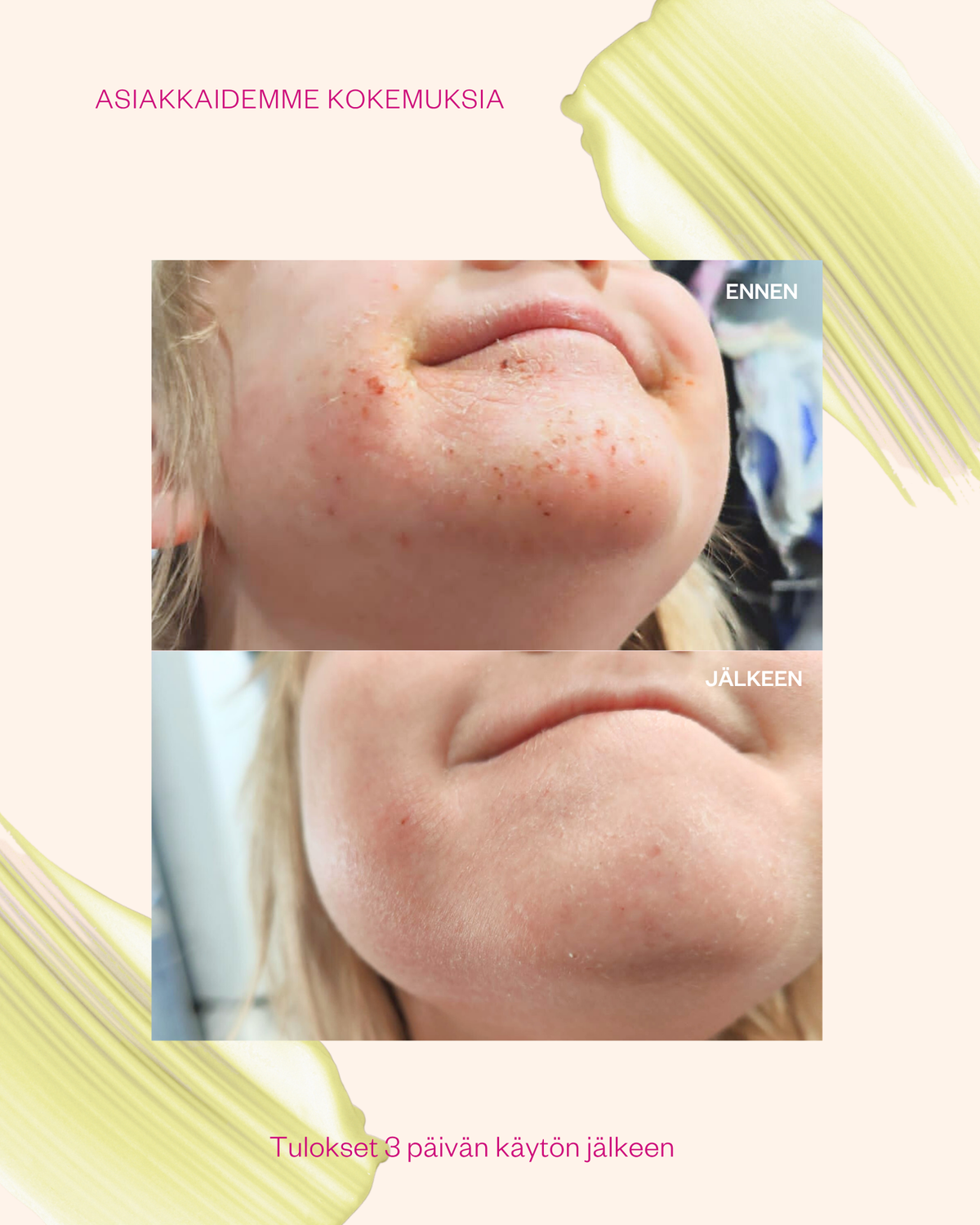 Propolis & Probiotics Rescue Cream erikoisvoide ongelmaiholle