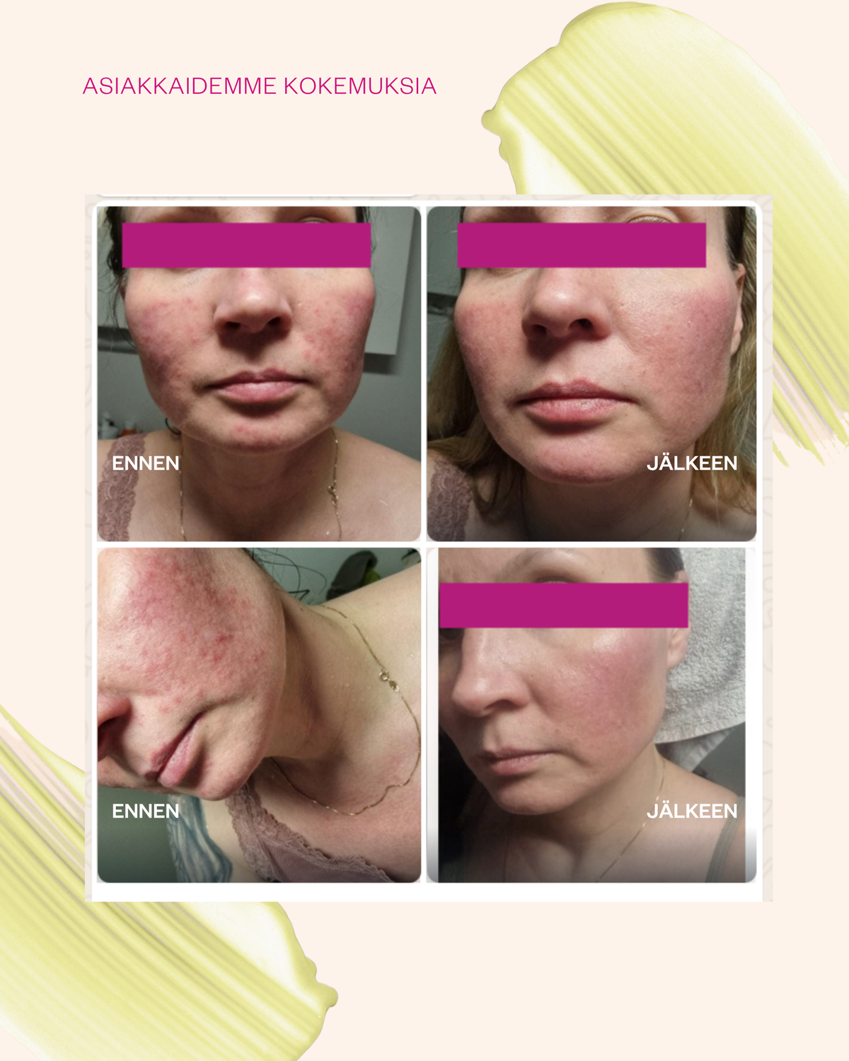 Propolis & Probiotics Rescue Cream erikoisvoide ongelmaiholle