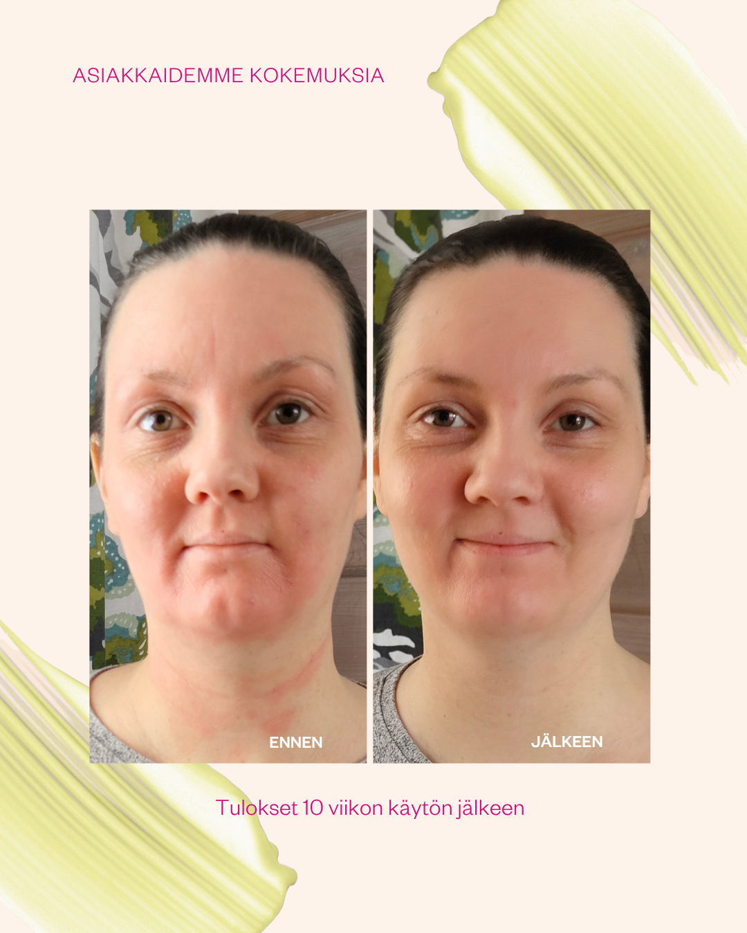 Flow Cosmetics Propolis & Probiotics Rescue Cream ärtynyt iho ennen ja jälkeen